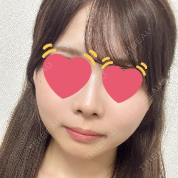バッカルファット除去 / 脂肪吸引（顔） / メーラーファット除去 / ヒアルロン酸注入（あご） PRISM Beauty Clinic 町田院 BEFORE メイン用