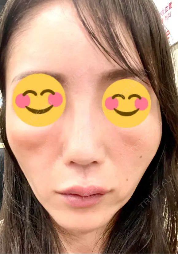 ヒアルロン酸注入（頬） 百人町アルファクリニック BEFORE メイン用