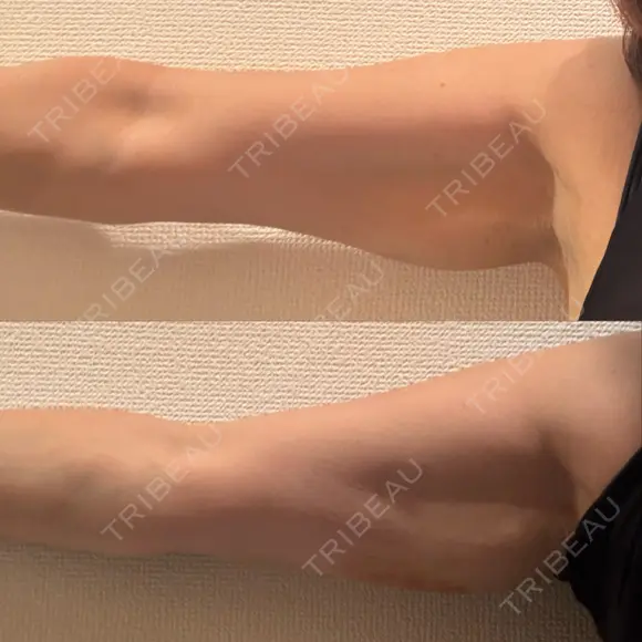 脂肪溶解注射（二の腕） FIG CLINIC BEFORE メイン用
