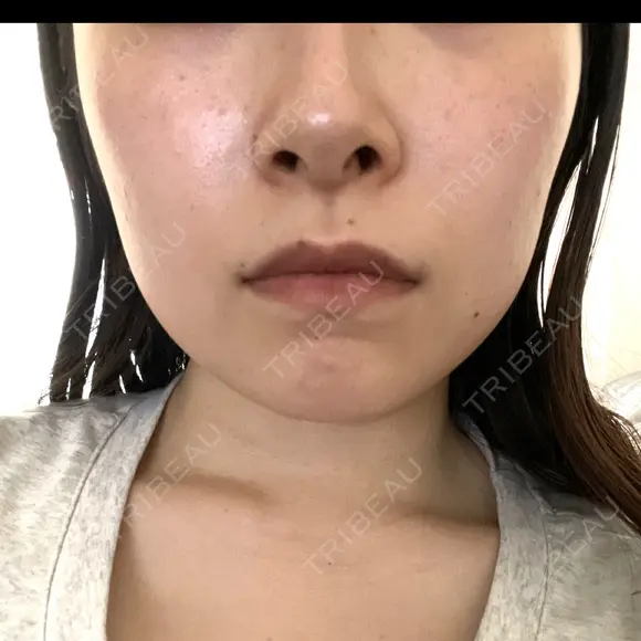 エレクトロポレーション / 光治療（フォトフェイシャルなど） / ピーリング（ハリ・ツヤ） トラスト美容クリニック 銀座院 BEFORE メイン用