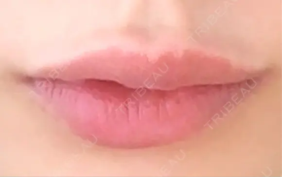 ヒアルロン酸注入（唇） 目白ホワイトクリニック BEFORE メイン用