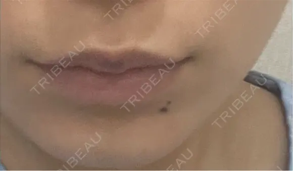 ボトックス（口角） mimi CLINIC BEFORE メイン用