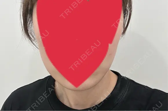 ハイフ（顔） 表参道メディカルクリニック 名古屋院 BEFORE メイン用