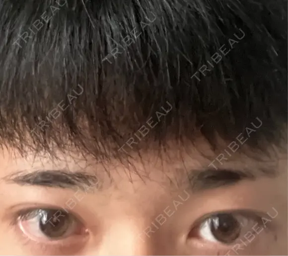 眉下切開 表参道ウィズ・クリニック BEFORE メイン用