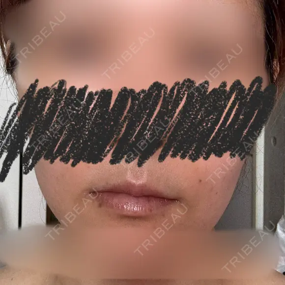 ヒアルロン酸注入（唇） 目白ホワイトクリニック BEFORE メイン用