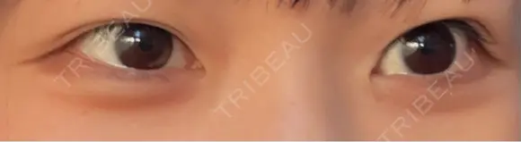 二重埋没 恵聖会クリニック 京橋院 BEFORE メイン用