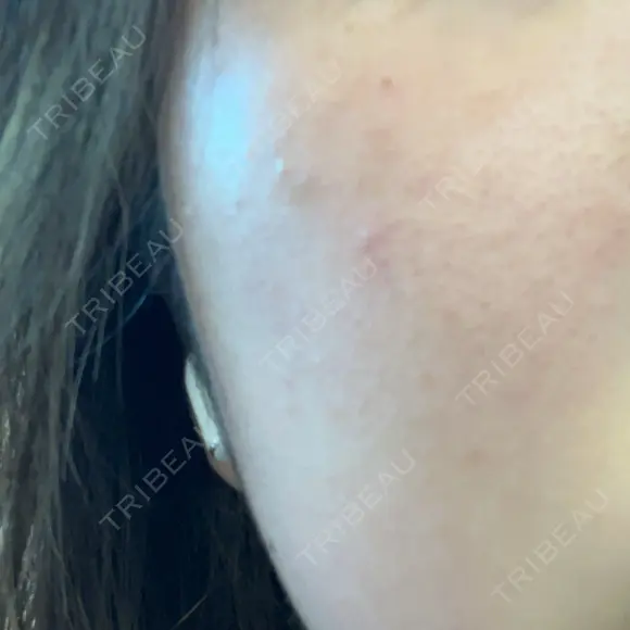 ルメッカ Grias clinic （ジリアスクリニック） BEFORE メイン用
