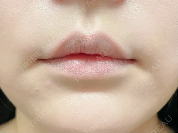 ヒアルロン酸注入（唇） 目白ホワイトクリニック BEFORE メイン用