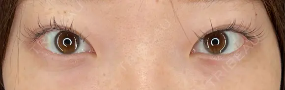 ヒアルロン酸注入（涙袋） / ボトックス（あご） / ヒアルロン酸注入（あご） HAAB×DREAM BEAUTY CLINIC 大阪梅田院 BEFORE メイン用