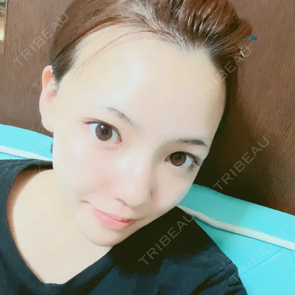 二重切開 / 目頭切開 / 眼瞼下垂（切開） / 軟骨移植 / 骨切幅寄せ / 斜鼻修正 id（アイディ）美容外科 BEFORE メイン用