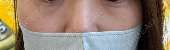 ルメッカ ルラ美容クリニック 上野院 BEFORE メイン用