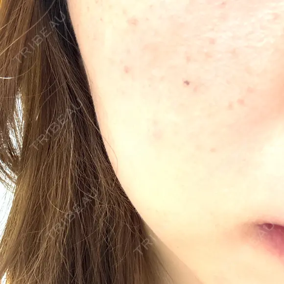 ルメッカ plume clinic BEFORE メイン用