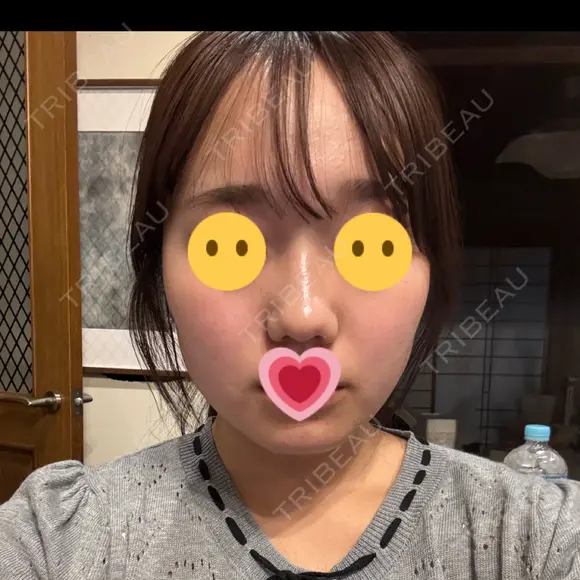 医療痩身（顔） plume clinic BEFORE メイン用