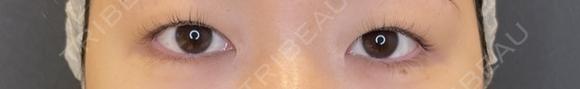 目尻切開 / タレ目形成・グラマラスライン（埋没） LOUIS CLINIC 二子玉川院【ルイクリニック】 BEFORE メイン用