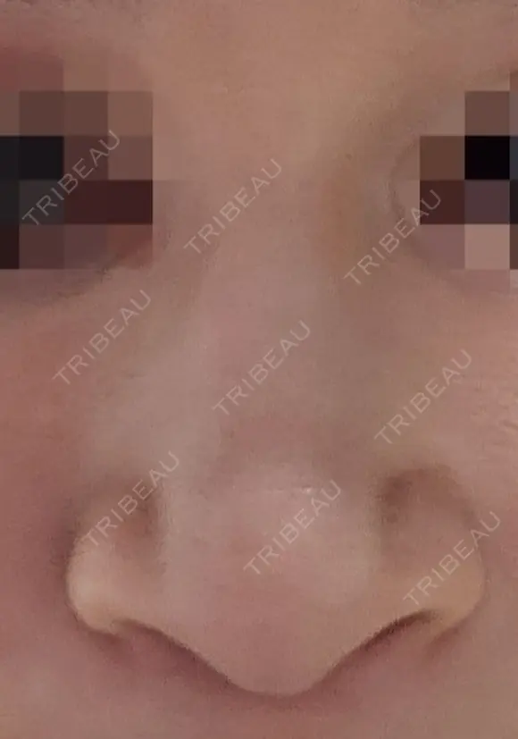 隆鼻術 / 鼻尖形成（切開） / 鼻中隔延長（切開） / その他（輪郭） リッツ美容外科 東京院 BEFORE メイン用