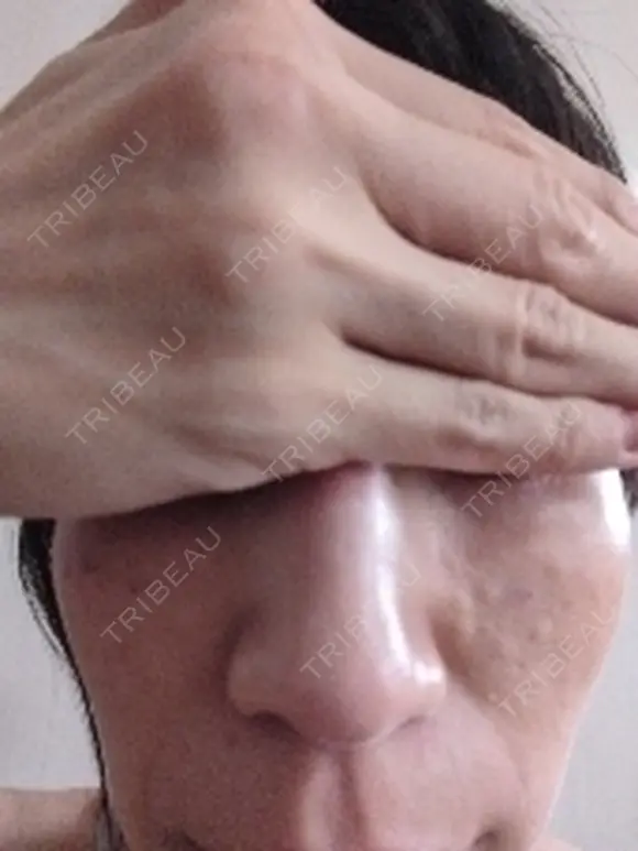 リジュラン ワンストップヘアクリニック 大阪院 BEFORE メイン用