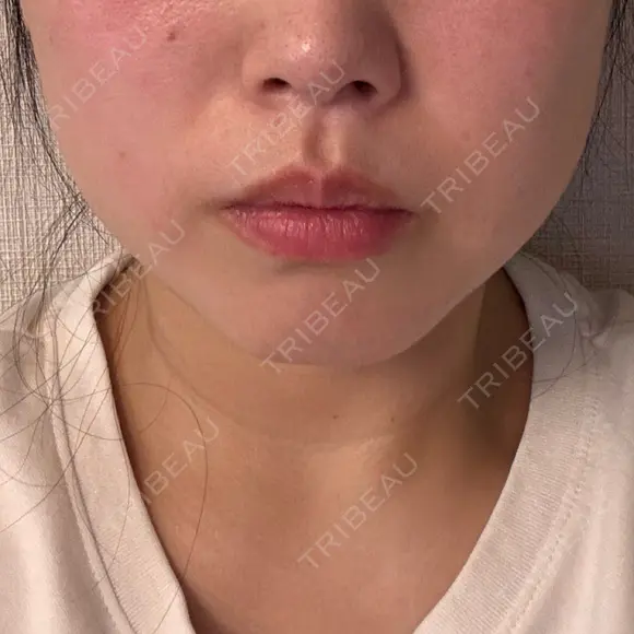 ハイフ（顔） AZ BEAUTY CLINIC BEFORE メイン用