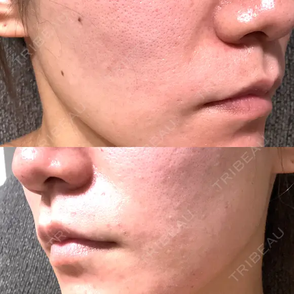 ポテンツァ ルラ美容クリニック 沖縄院 BEFORE メイン用