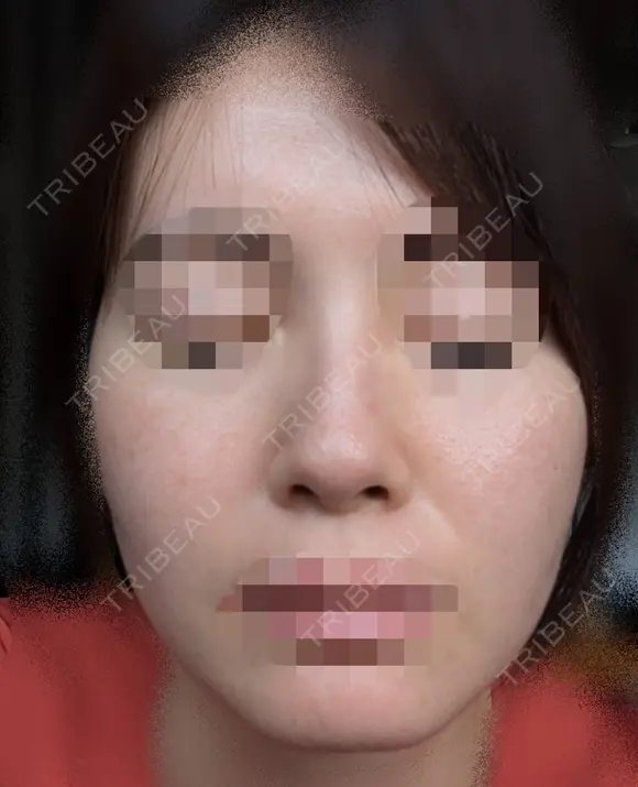 鼻尖縮小 / ヒアルロン酸注入（鼻） 東京ヒルズクリニック 銀座院 BEFORE メイン用