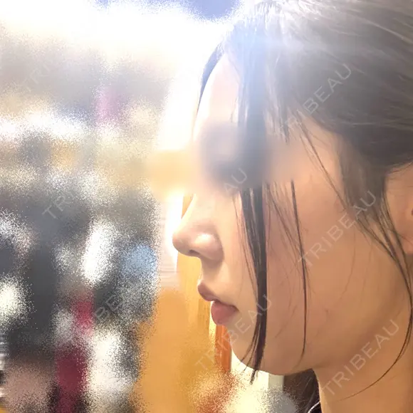 ヒアルロン酸注入（額） 札幌TAクリニック BEFORE メイン用