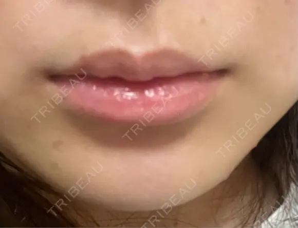 ヒアルロン酸注入（唇） 目白ホワイトクリニック BEFORE メイン用