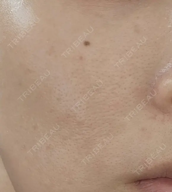 ルメッカ ルラ美容クリニック 名古屋栄院 / ルラスキンクリニック 名古屋栄院 BEFORE メイン用