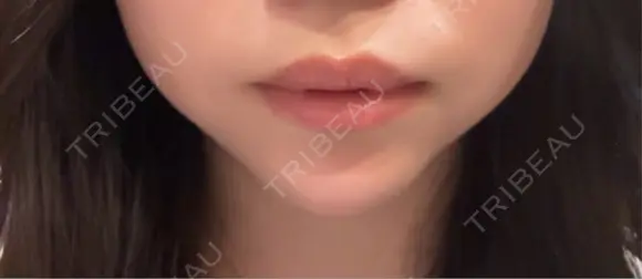 ボトックス（口角） AURORA CLINIC（オーロラクリニック）新宿院 BEFORE メイン用