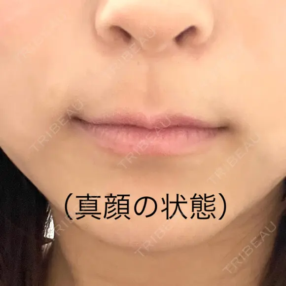 ボトックス（口角） J CLINIC BEFORE メイン用