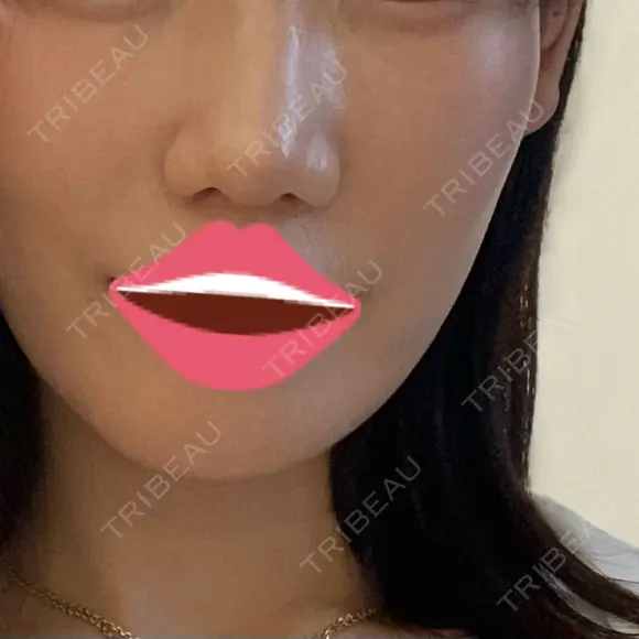 肌育注射（ジュベルックなど） / イオン導入 / ピーリング（ハリ・ツヤ） ゆう美容クリニック BEFORE メイン用