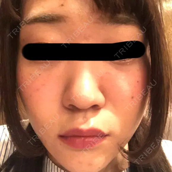 ニキビ治療 石井クリニック 青山サロン BEFORE メイン用