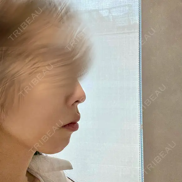 ボトックス（あご） / 肌ヒアルロン酸注入（たるみ・シワ改善） plume clinic BEFORE メイン用