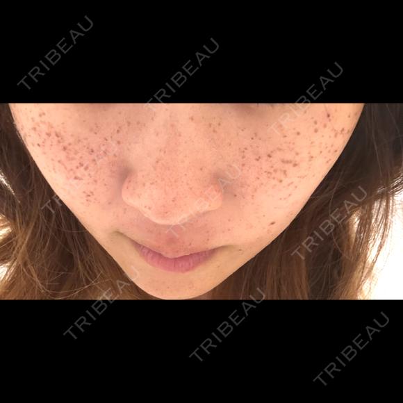 ピーリング（ニキビ・毛穴） / ルメッカ ルラ美容クリニック 横浜院 BEFORE メイン用