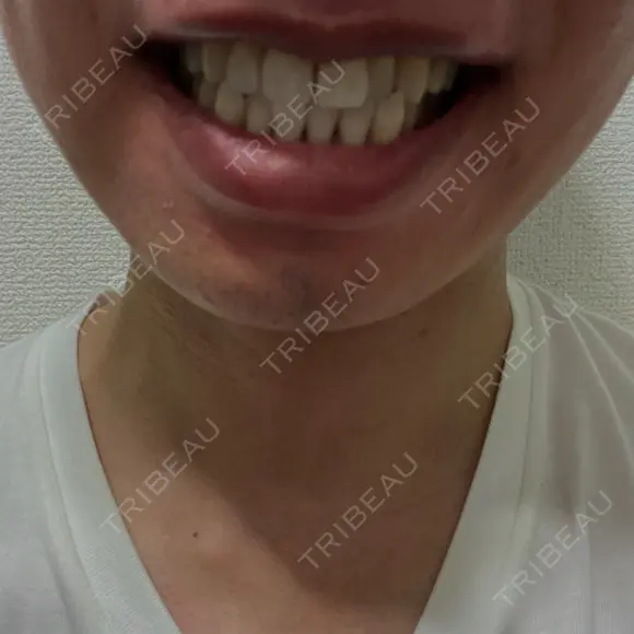 ホワイトニング ビジューデンタルサロン BEFORE メイン用