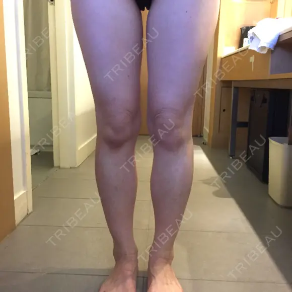 脂肪吸引（脚） / 肌ヒアルロン酸注入（たるみ・シワ改善） プチパーティー医院 BEFORE メイン用