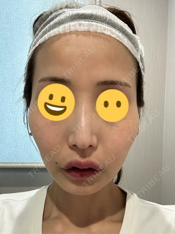 水光注射（ハリ・美肌） ちぐさ内科クリニック 覚王山 BEFORE メイン用