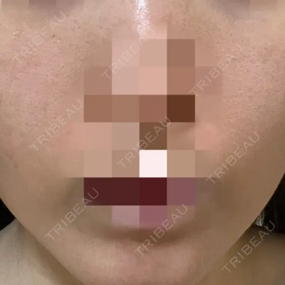 ポテンツァ ルラ美容クリニック 岡山院 BEFORE メイン用