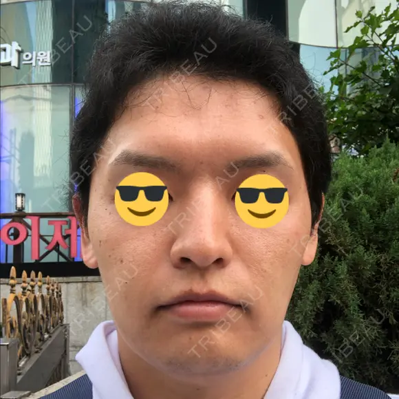 バッカルファット除去 / 脂肪吸引（顔） グロービー美容整形外科 BEFORE メイン用