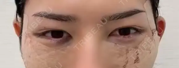 クマ治療 / その他（輪郭） WOM CLINIC GINZA （ワム クリニック ギンザ） BEFORE メイン用