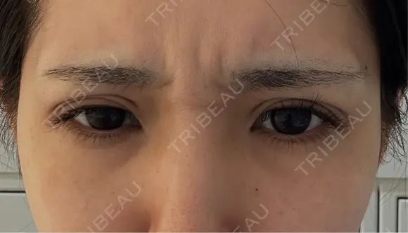 ボトックス（あご） / ボトックス（エラ・小顔） / ボトックス（口角） / ボトックス（眉間） Belle Via Skin Clinic BEFORE メイン用