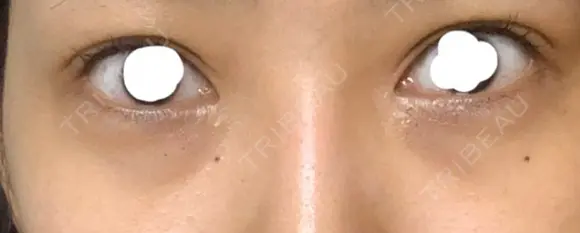 クマ治療 / 下まぶたの脂肪取り ララ整形外科 BEFORE メイン用