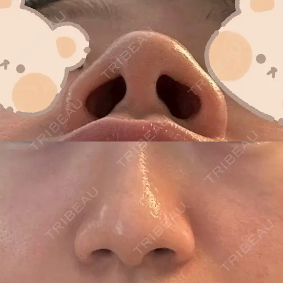 鼻尖形成（切開） / 小鼻縮小（切開） / 軟骨移植 ASTRA BEAUTY CLINIC BEFORE メイン用