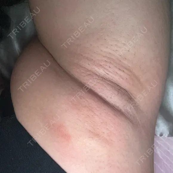 ワキ汗治療（レーザー） ゆう美容クリニック BEFORE メイン用