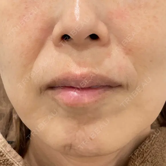 ハイフ（顔） ARTE BEAUTY CLINIC BEFORE メイン用