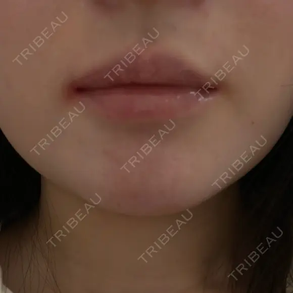 ボトックス（口角） / ボトックス（人中） DMTC CLINIC 日本橋院 BEFORE メイン用