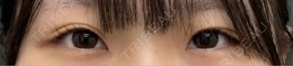 目頭切開 ネビュラクリニック 京都院 BEFORE メイン用