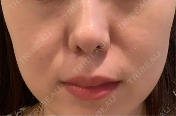 リジュラン 新宿Ladies&Gentlemen美容クリニック BEFORE メイン用