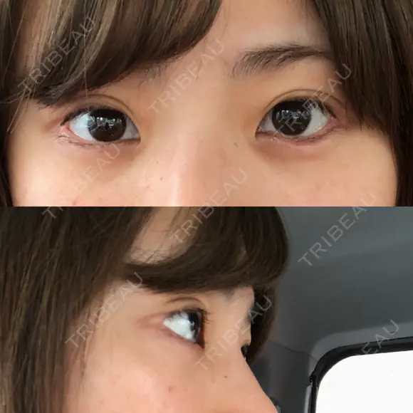 ヒアルロン酸注入（涙袋） 湘南美容クリニック 岐阜院 BEFORE メイン用