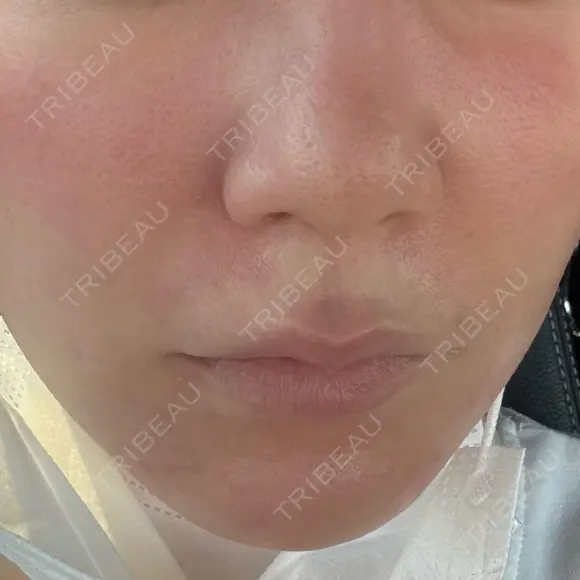 糸リフト Wing clinic 豊中駅前院 BEFORE メイン用