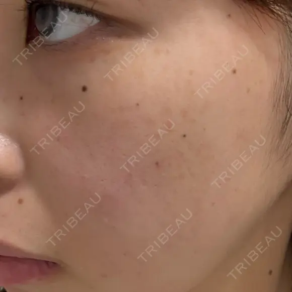 ルメッカ ルラ美容クリニック 大宮院 / ルラスキンクリニック 大宮院 BEFORE メイン用