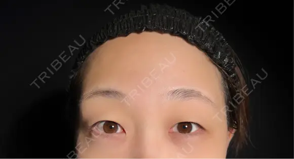 二重埋没 / 上まぶたの脂肪取り 9BeautyClinic BEFORE メイン用
